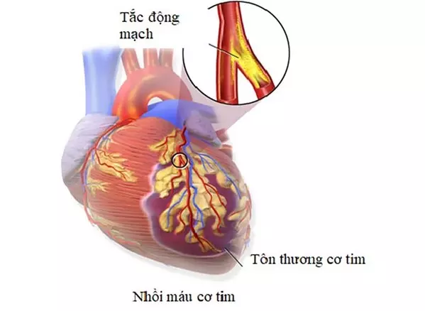 Thiếu máu cơ tim có nguyên nhân từ các mảng xơ vữa, cục máu đông gây tắc mạch.webp